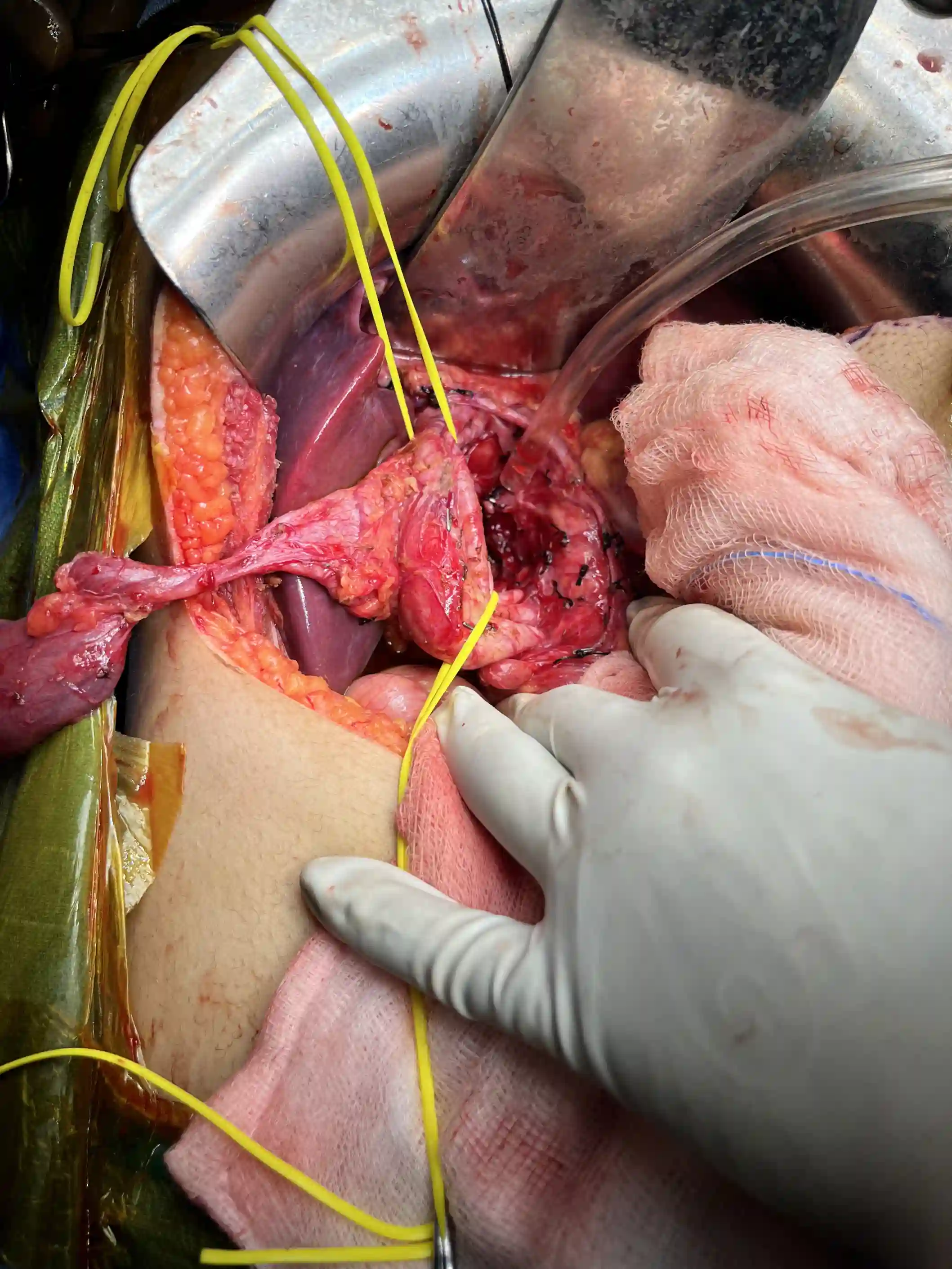 Complex biliary procedure &mdash; Advitya Healthcares