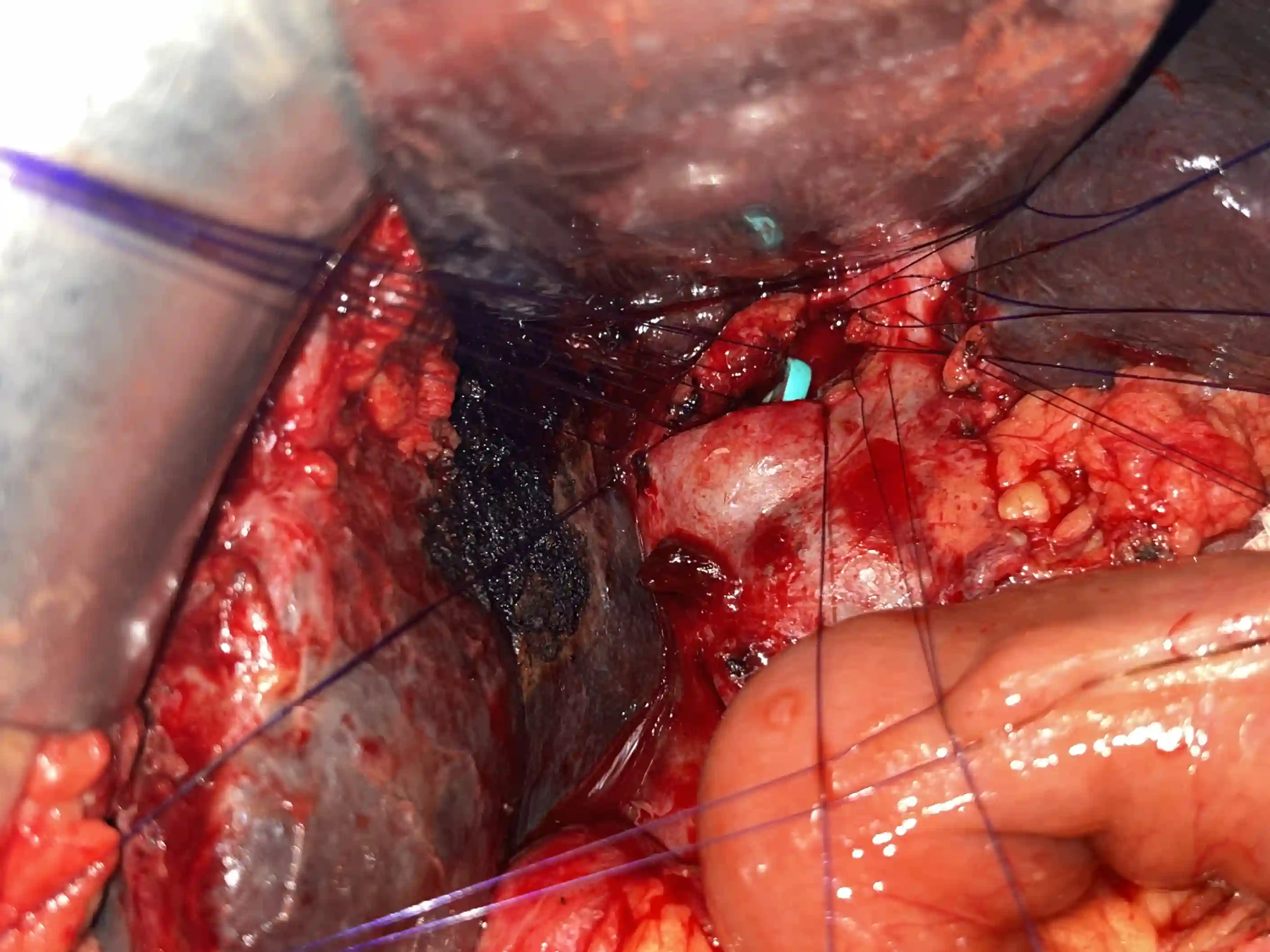 Complex biliary procedure &mdash; Advitya Healthcares