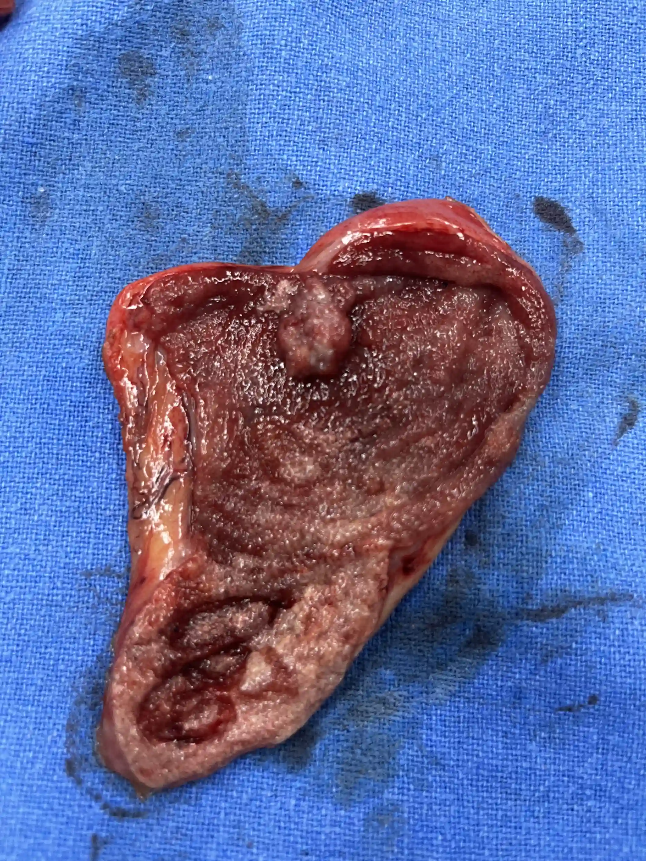 Complex biliary procedure &mdash; Advitya Healthcares