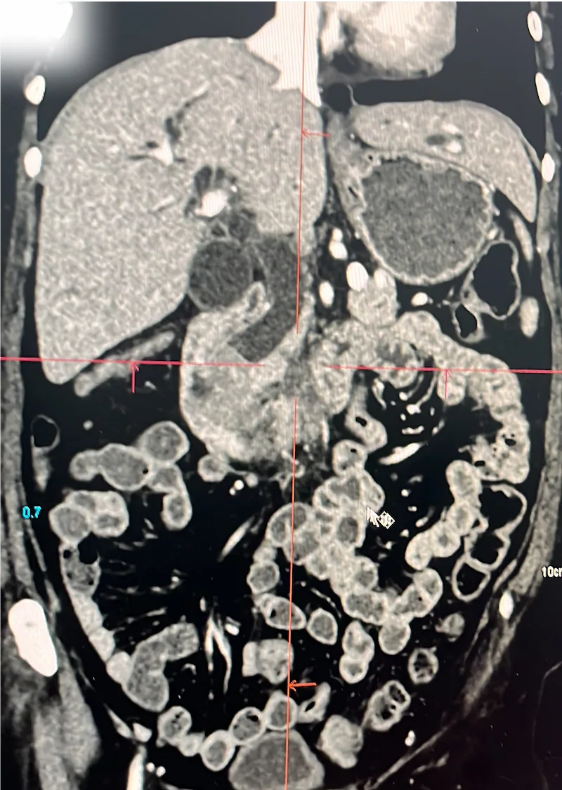 Complex pancreatic procedure &mdash; Advitya Healthcares