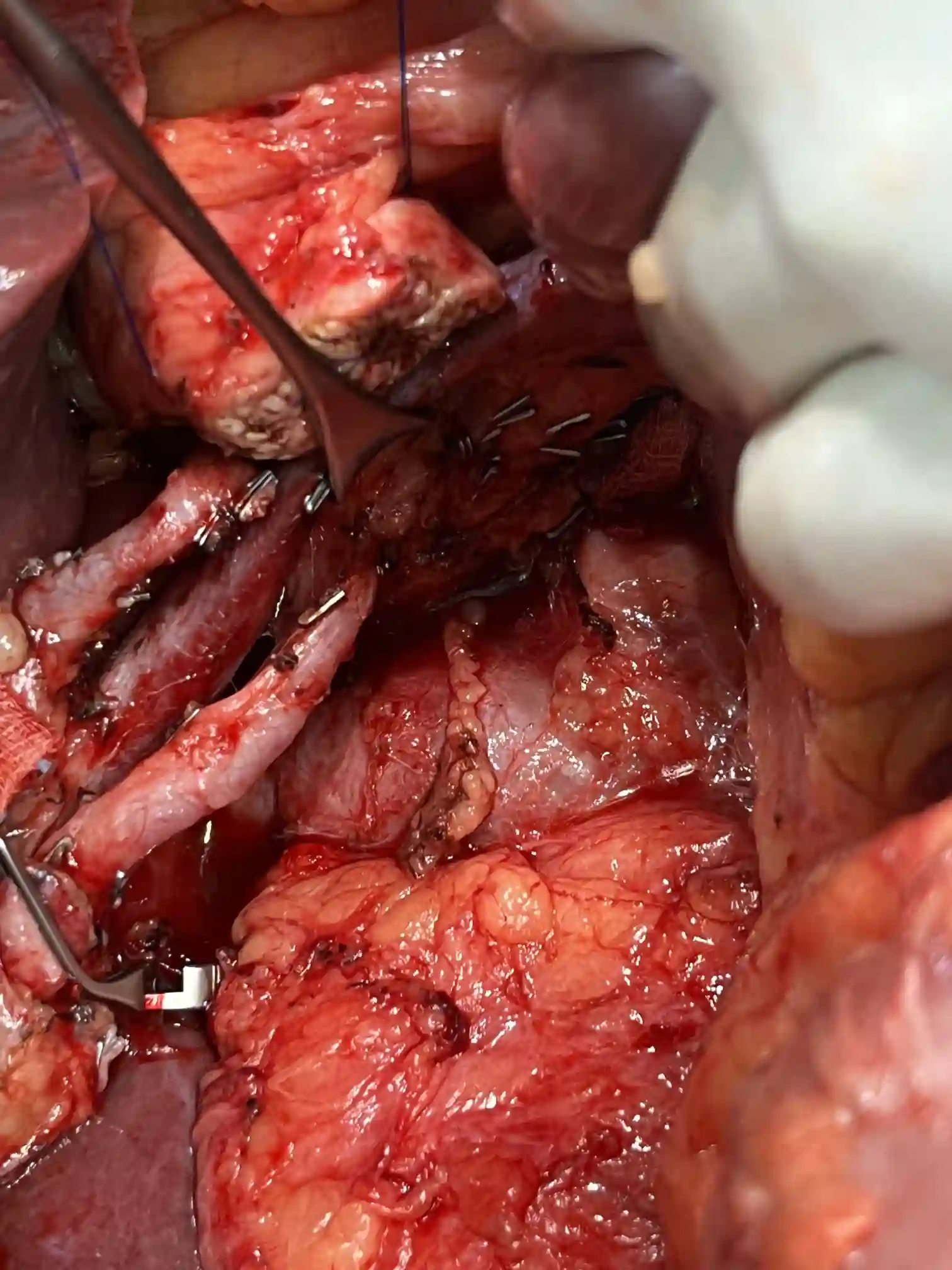 Complex pancreatic procedure &mdash; Advitya Healthcares