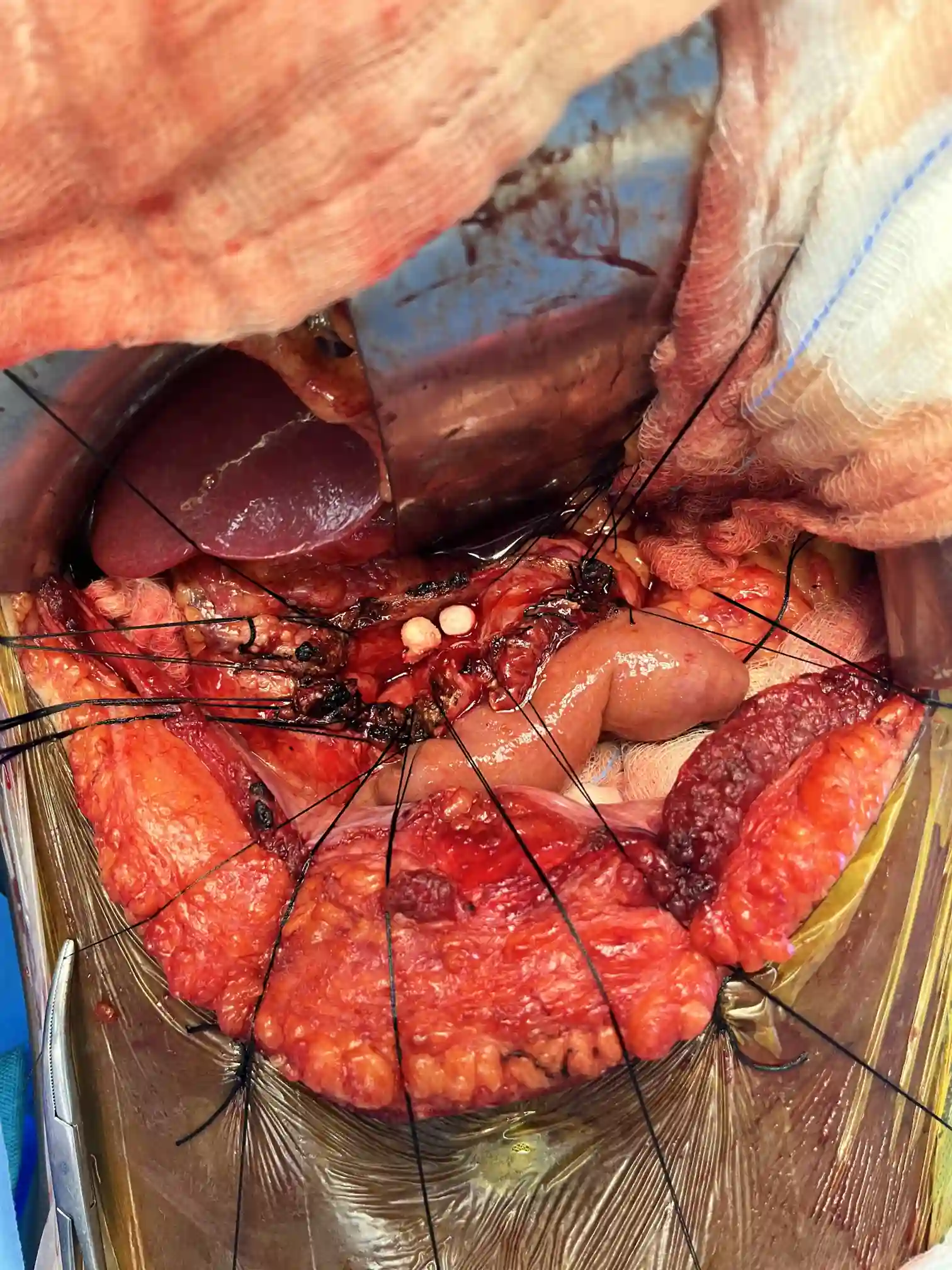 Complex pancreatic procedure &mdash; Advitya Healthcares