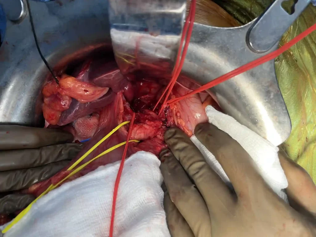 Complex pancreatic procedure &mdash; Advitya Healthcares