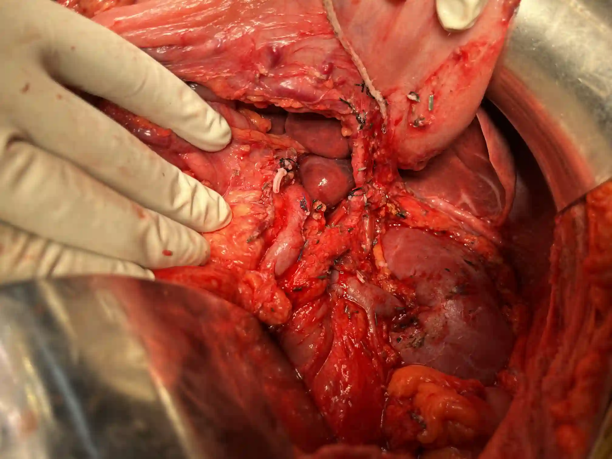 Complex pancreatic procedure &mdash; Advitya Healthcares