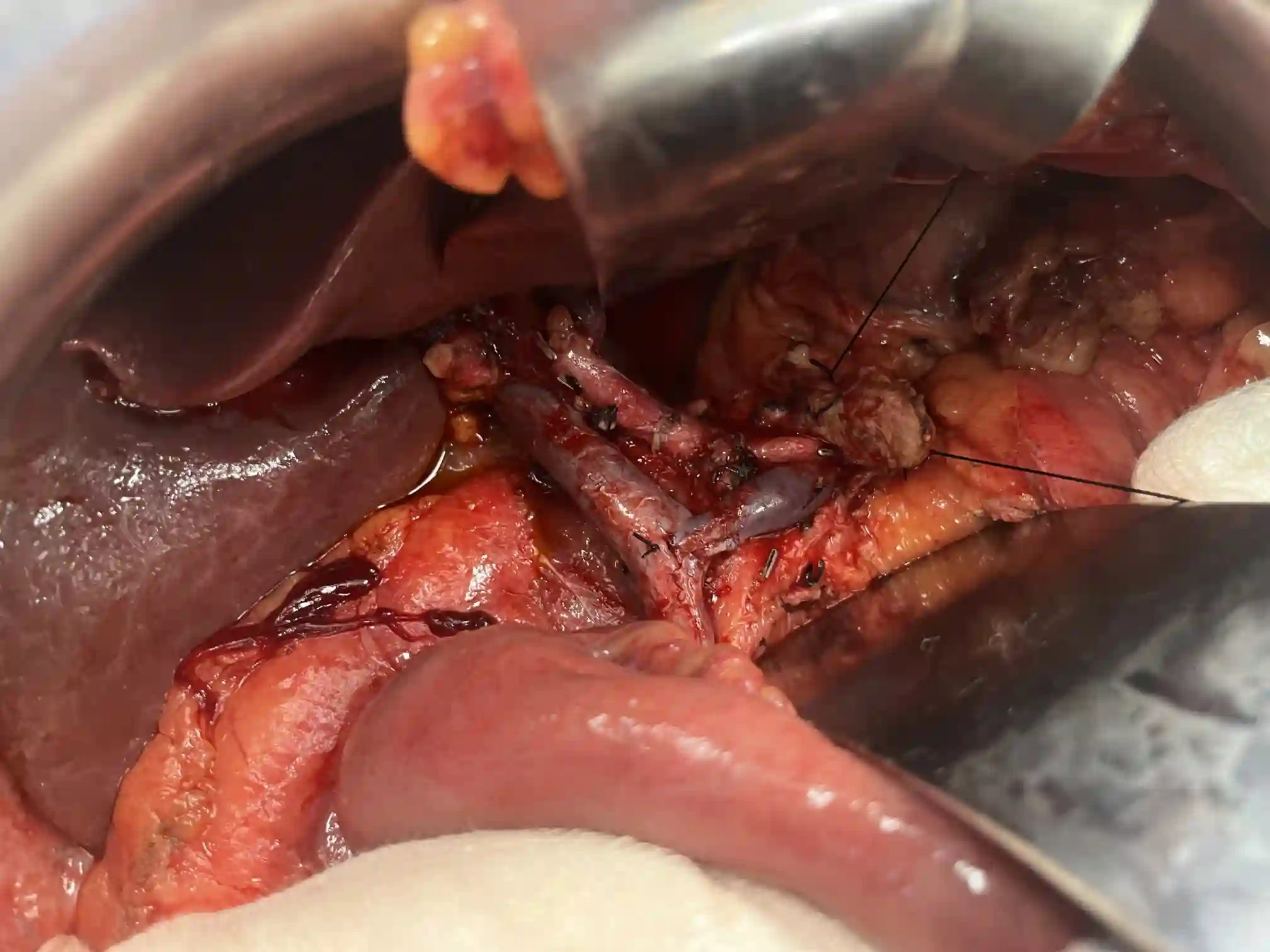 Complex pancreatic procedure &mdash; Advitya Healthcares