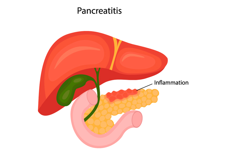 Pancreatic Disorders