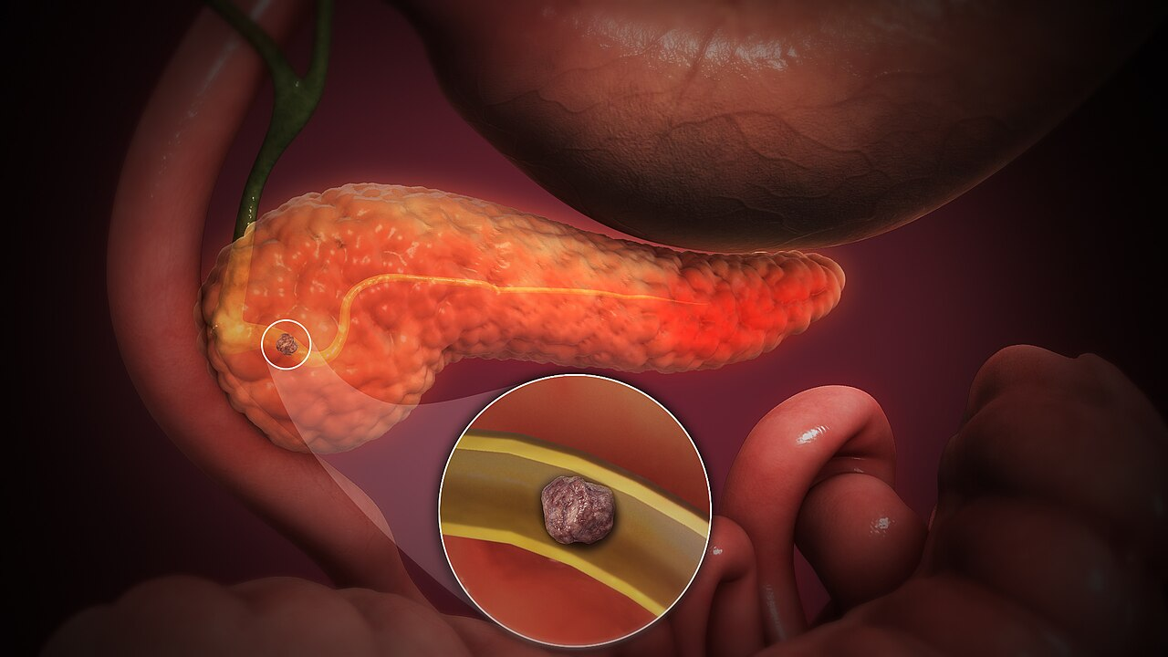 Three-dimensional illustration of acute pancreatitis, showing a stone lodged in the pancreatic duct with inflamed pancreatic tissue