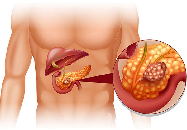 Illustration of the pancreas within the abdomen, with a magnified view of diseased pancreatic tissue