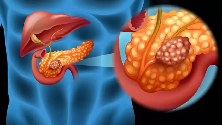 Illustration of pancreatic cancer, with a magnified view of a tumour mass in the pancreas