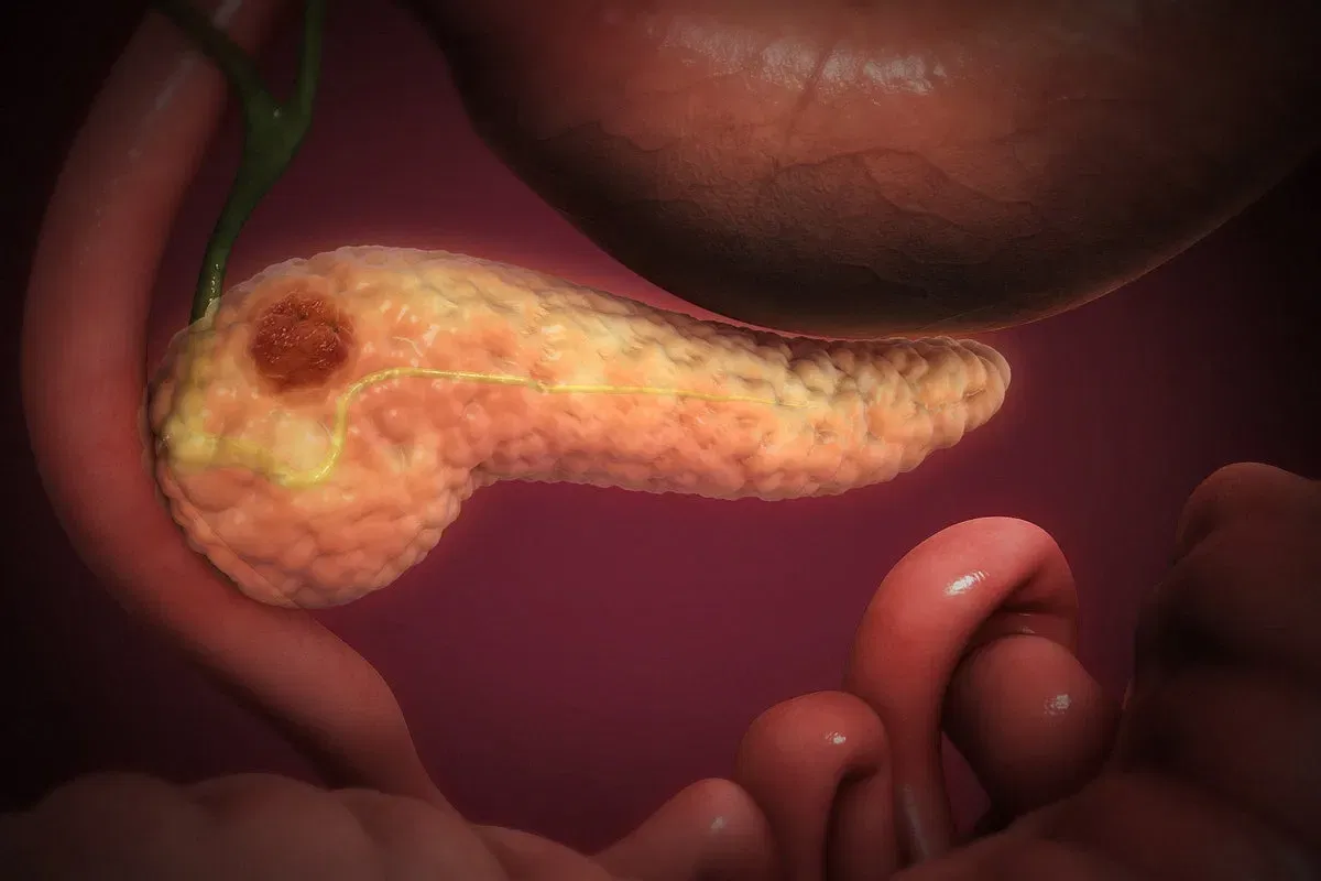 Three-dimensional illustration of the pancreas with a rounded lesion in the head of the gland