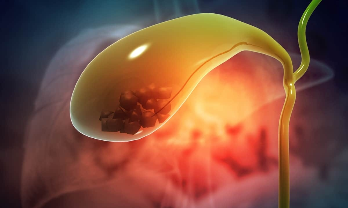 Three-dimensional illustration of the gallbladder with gallstones inside it, and the cystic duct draining into the common bile duct