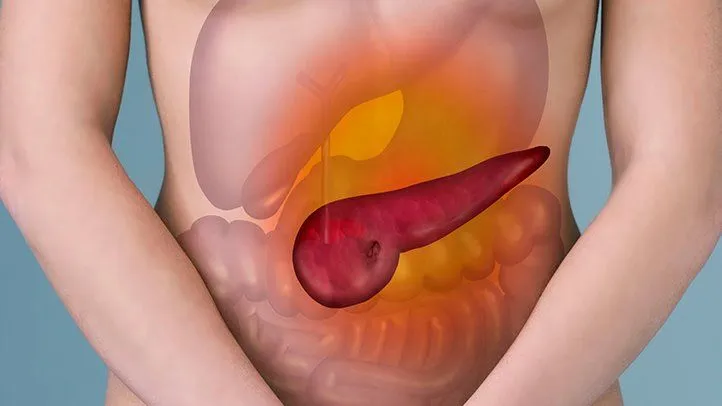 Illustration of an inflamed pancreas seen through the abdomen, with the patient holding the upper abdomen