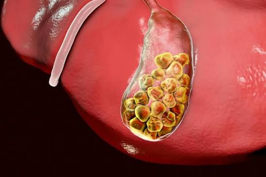 Three-dimensional medical illustration of a gallbladder packed with gallstones, shown against the liver