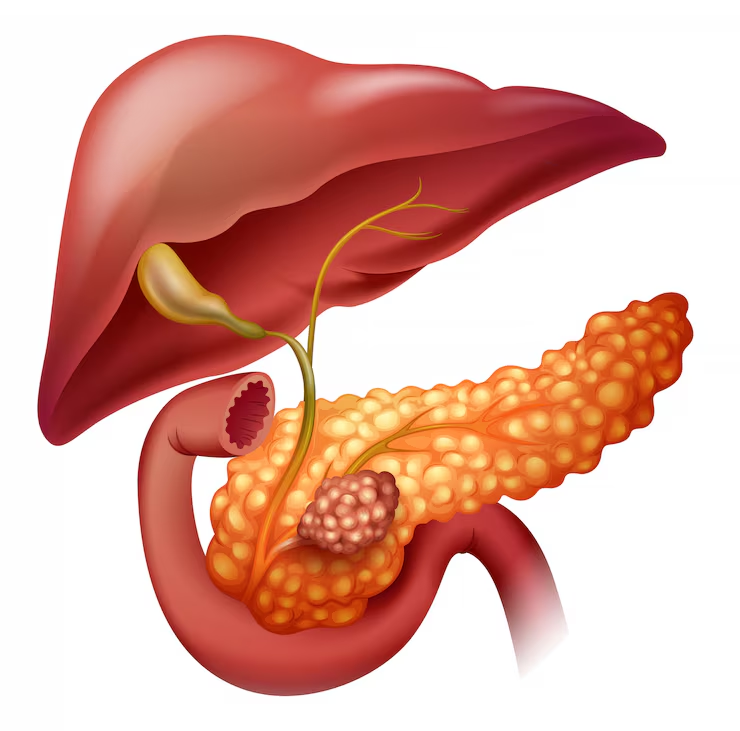 Medical illustration of the pancreas with the liver, gallbladder, bile ducts and duodenum, showing a tumour in the head of the gland