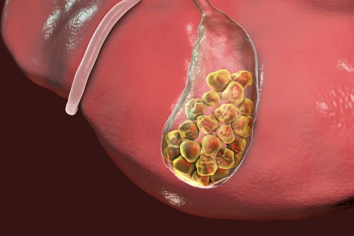 Medical illustration of a gallbladder filled with clustered cholesterol deposits