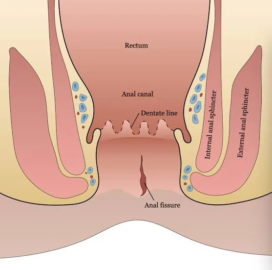 Labelled illustration of the anal canal showing a fissure below the dentate line