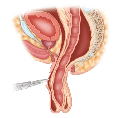 Side-view illustration of the anal canal and rectum during an anal fistula procedure