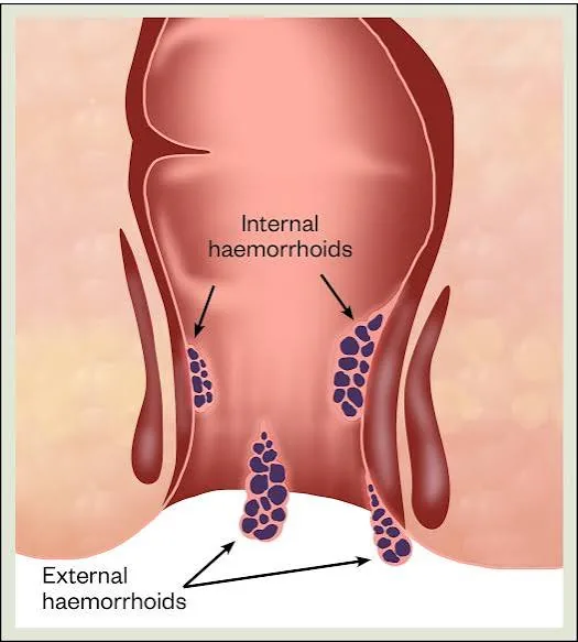 Labelled illustration of internal and external haemorrhoids around the anal canal
