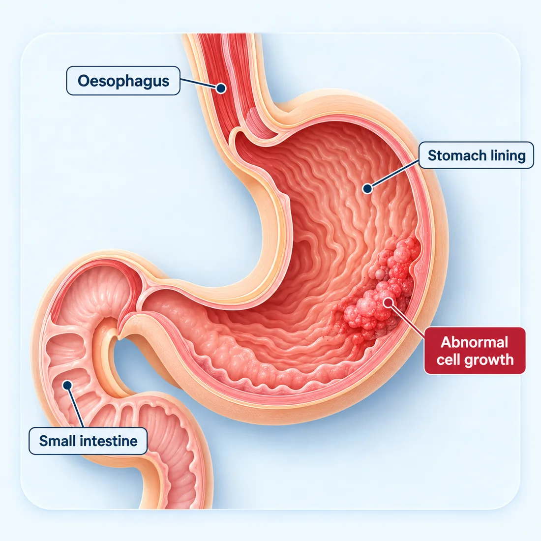 Cutaway diagram of the stomach labelling the oesophagus, the stomach lining, an area of abnormal cell growth on the lining, and the small intestine