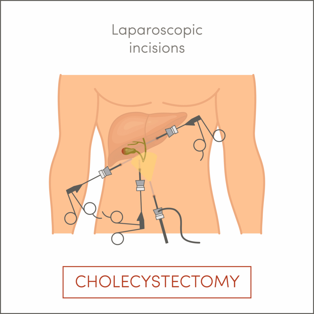 Cholecystectomy laparascopic incisions