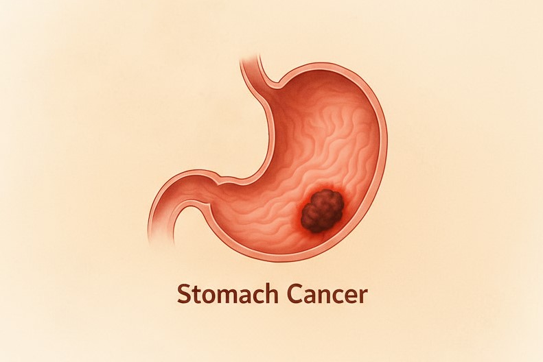 Gallbladder Cancer