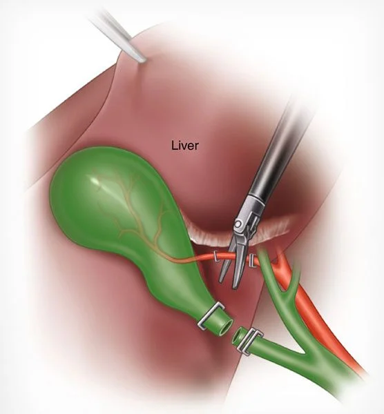 Gallbladder surgery image