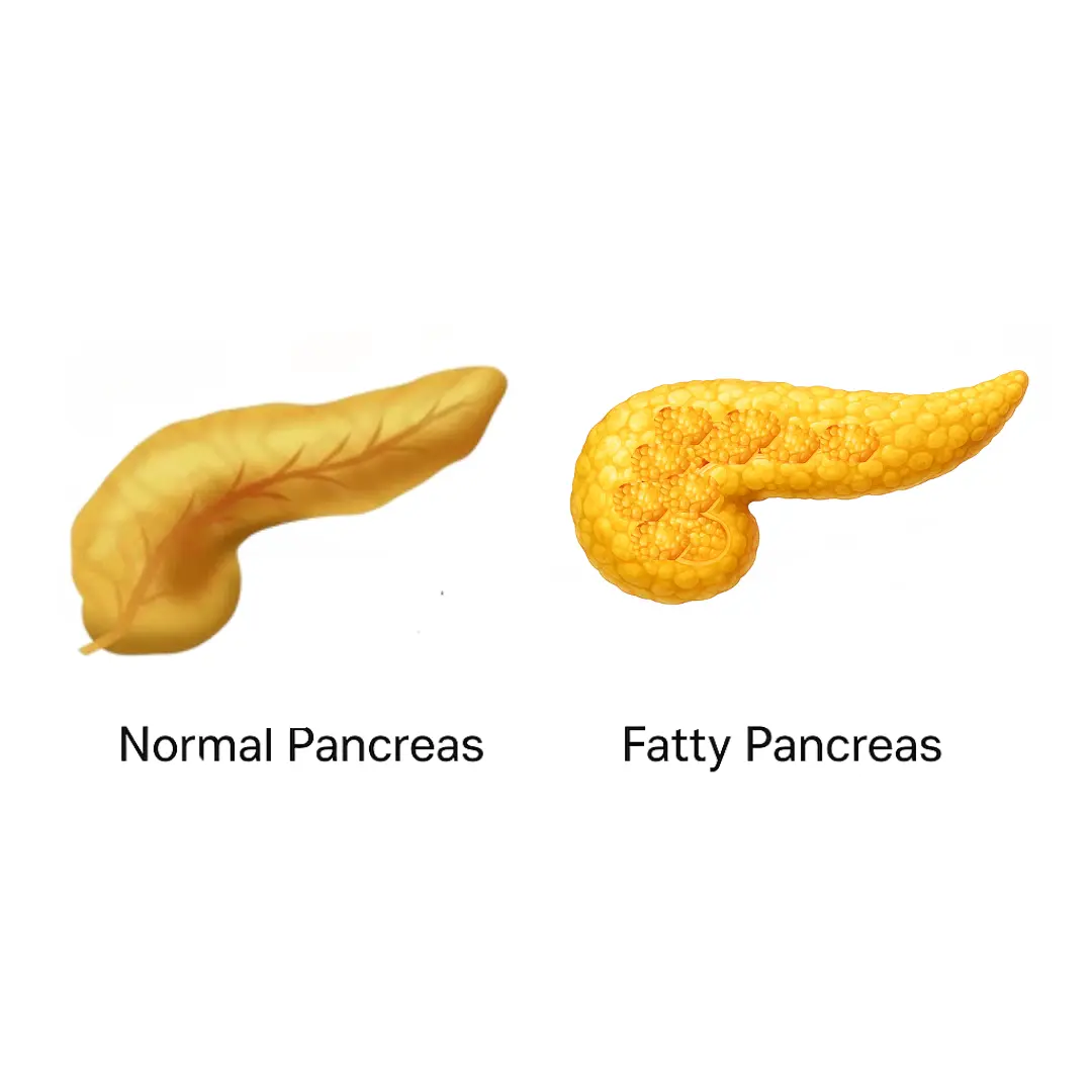 Fatty Pancreas: The Silent Condition You Shouldn’t Ignore