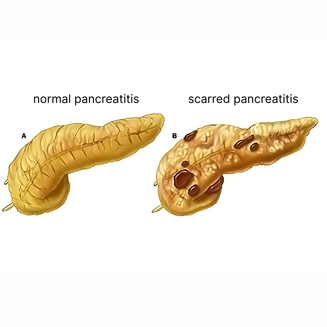 Chronic Pancreatitis: When Inflammation Becomes Permanent