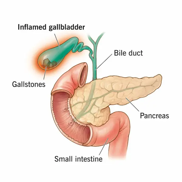 Patient eating healthy with enzymes beside plate, caption 'Living Well with Chronic Pancreatitis' Advitya healthcare