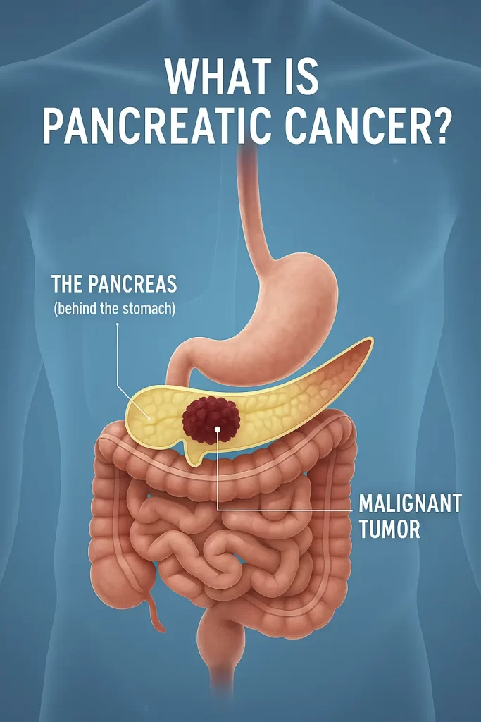 What is pancreatic cancer
