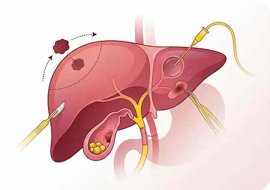 Biliary & Liver Surgery | Advitya healthcares in Kolkata | Advitya healthcares in Ranchi | Advitya healthcares in delhi | stomach doctor in Ranchi | Stomach Doctor in Kolkata