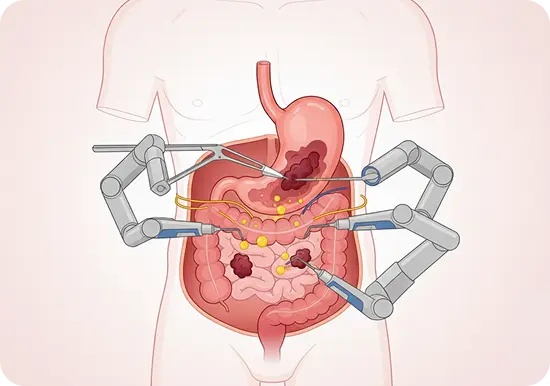 Gastrointestinal Oncology | Advitya healthcares in Kolkata | Advitya healthcares in Ranchi | Advitya healthcares in delhi | stomach doctor in Ranchi | Stomach Doctor in Kolkata