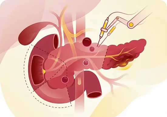 Pancreatic Surgery | Advitya healthcares in Kolkata | Advitya healthcares in Ranchi | Advitya healthcares in delhi | stomach doctor in Ranchi | Stomach Doctor in Kolkata